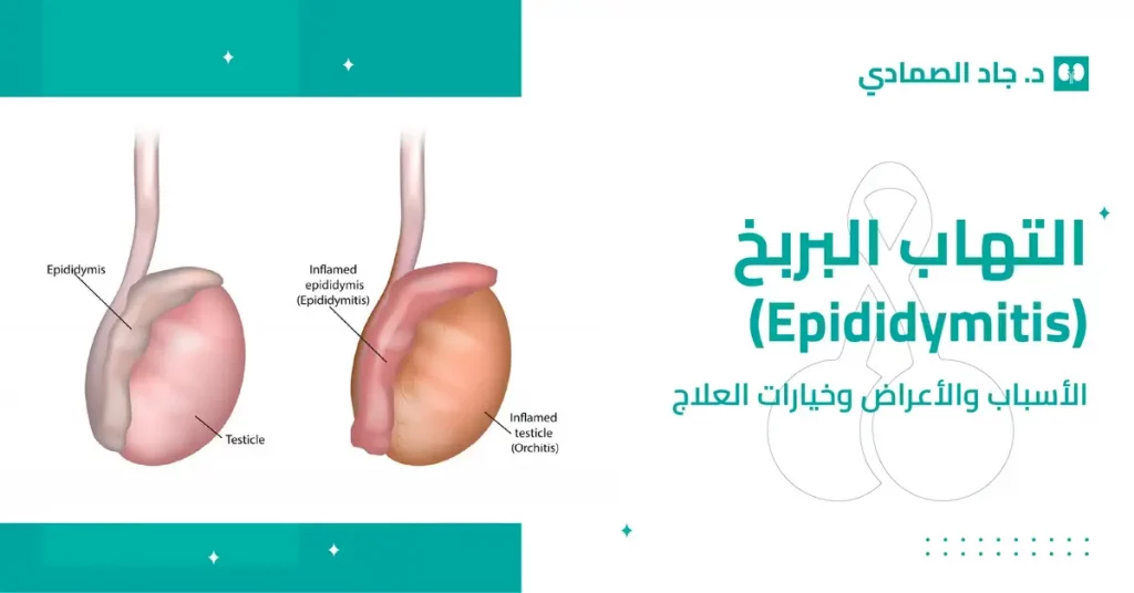 التهاب البربخ (Epididymitis) الأسباب والأعراض وخيارات العلاج